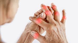 All You Need To Know About Arthritis